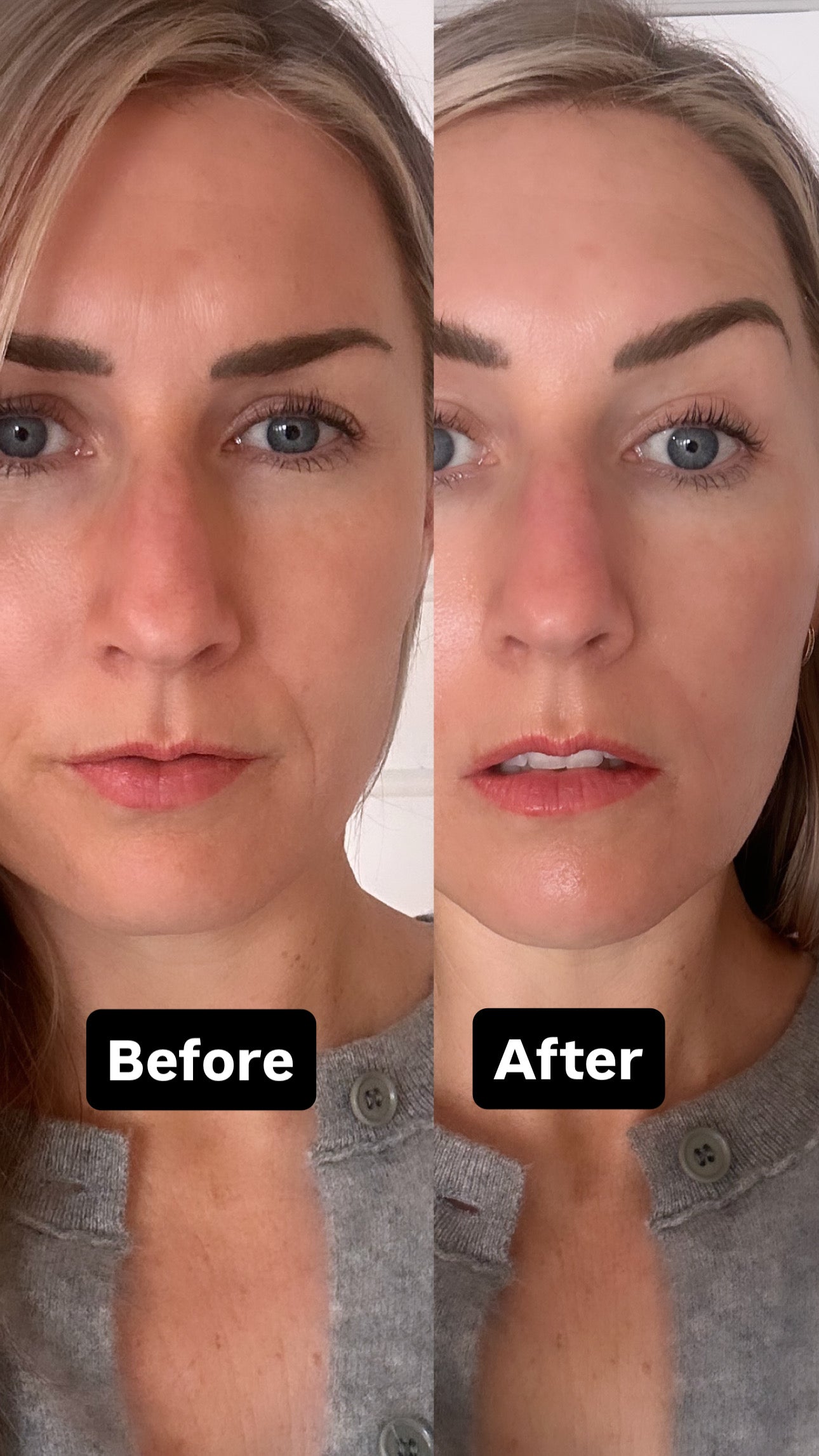 Ultra Face Lift Tool